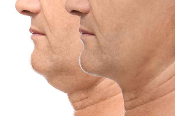 HIFU - Breakthrough in Anti - ageing 2 hifu results Felixstowe