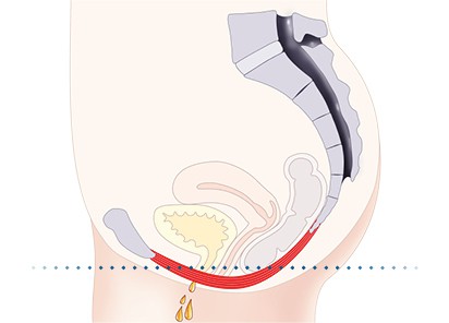 Pelvic-Floor Muscle Repair 5 Pelvic floor muscles Felixstowe