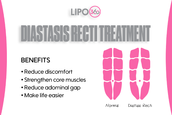 Revolutionising Muscle Repair: The Power of LIPO360 Body Sculpt Post-Injury 5 diastasis recti treatment Felixstowe