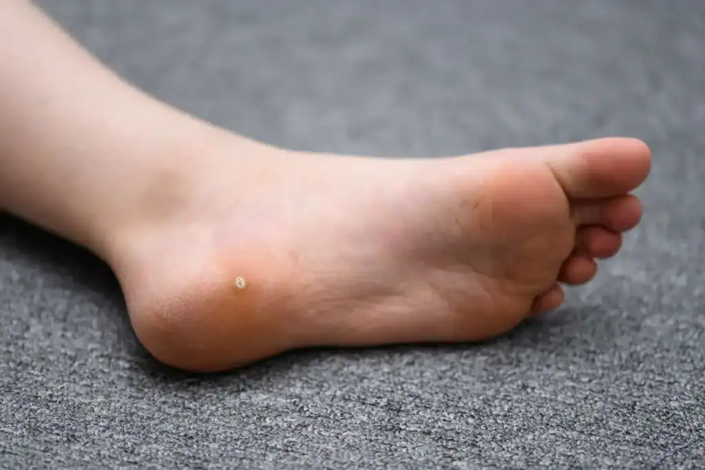 Cryotherapy For Warts And Also Verrucas 2 Image of verruca on the bottom of the foot that able to be treated with Cryotherapy Felixstowe