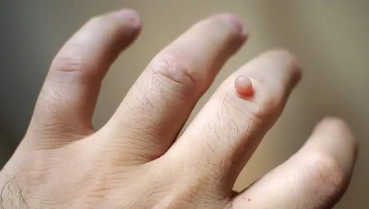 Image of blemish that Cryotherapy Felixstowe can remove with Lipo 360.