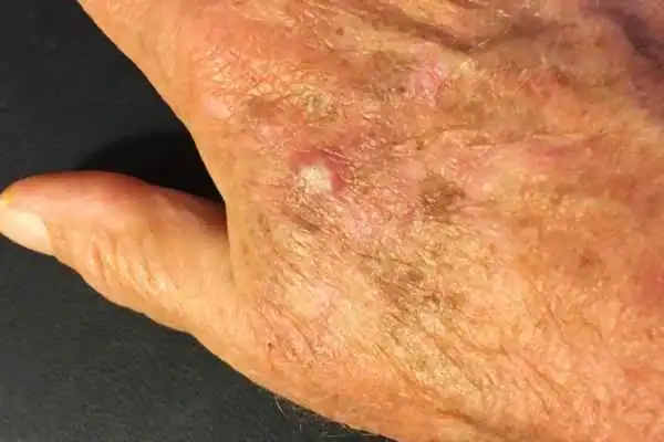 Image of Actinic keratoses Felixstowe on a person hand
