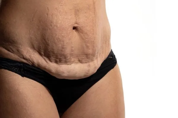 The science behind skin tightening Felixstowe picture of a woman's sagging skin on the stomach